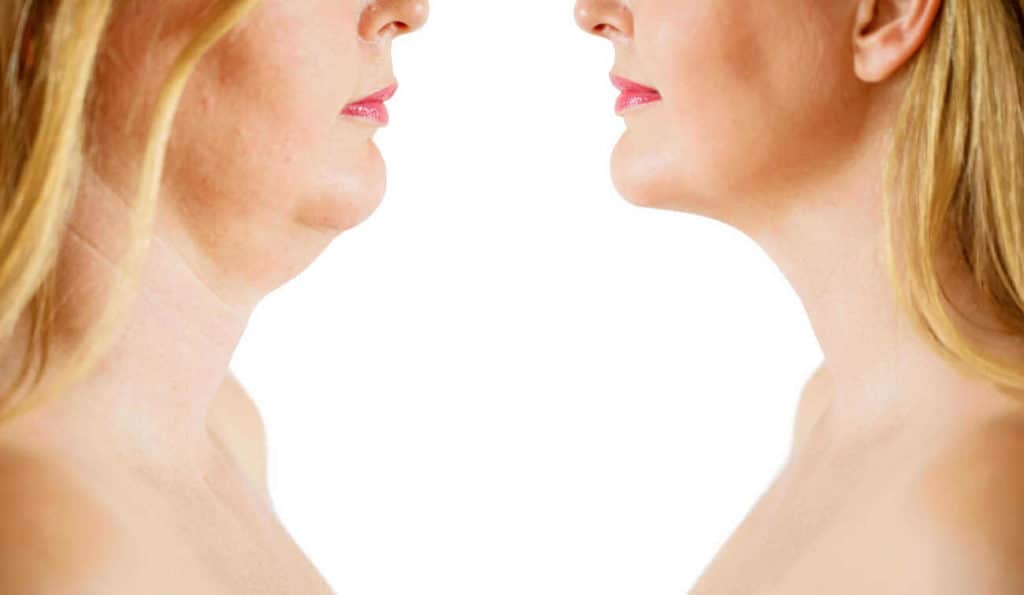Double Chin treatment Royal Wootton Bassett before and after results