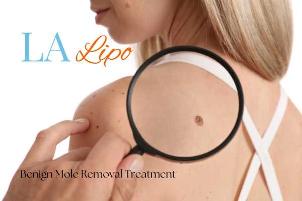 Woman having her inspection of blemish before mole removal Royal Wootton Bassett