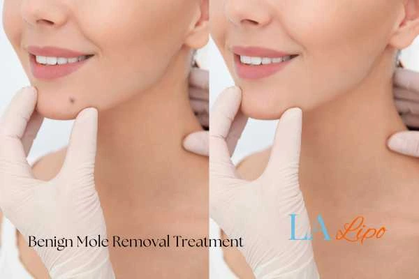 Before and after mole removal Royal Wootton Bassett treatment
