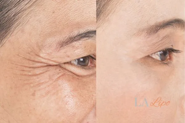 Before and after results of woman - HI-fu wrinkles reduction treatment Royal Wootton Bassett