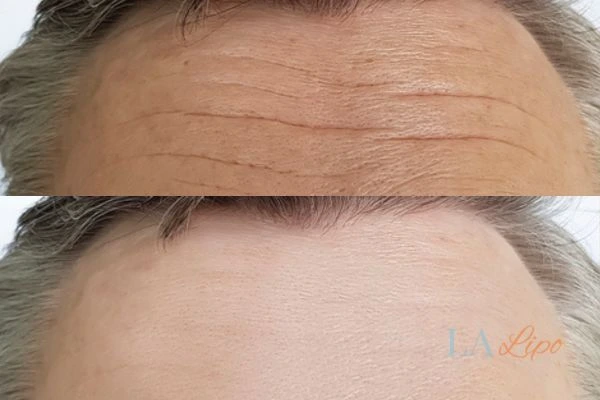results of HIFU Royal Wootton Bassett on mans forehead to help reduce lines and wrinkles