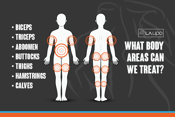 Graphic to show areas you can have LA-EMS Body Sculpting Royal Wootton Bassett treatment.