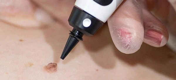 skin tag removal using cryopen Royal Wootton Bassett