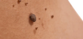 image of a skin tag Royal Wootton Bassett