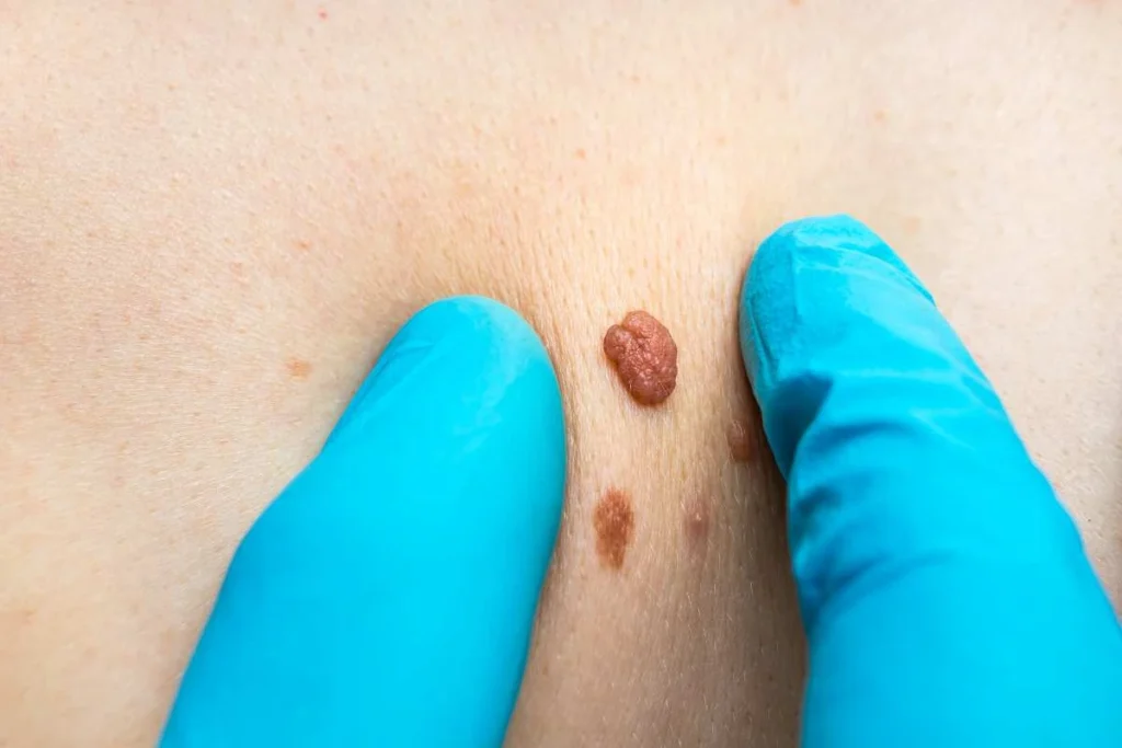 Consultant examining a skin tag Royal Wootton Bassett