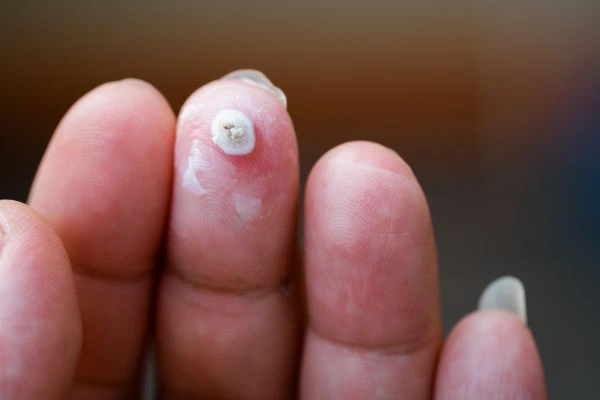 wart on person finger - cryotherapy to treat from LA LIPO Royal Wootton Bassett