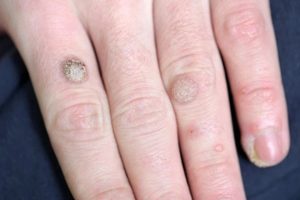 photo of warts on person hand - see wart removal Royal Wootton Bassett from LA LIPO