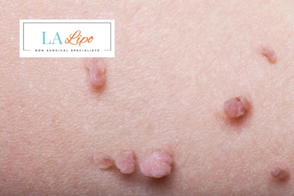 Does cryopen skin tag removal Royal Wootton Bassett hurt? Find out now call our team today!