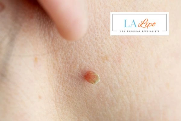 Book skin tag removal Royal Wootton Bassett today speak to our team now!