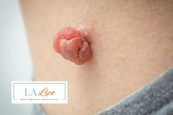 Interested in skin tag removal Royal Wootton Bassett? Concerned about the pain? Find out more today!