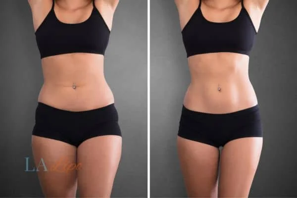 before and after results of non-surgical treatment to help a woman's body image and mental health Royal Wootton Bassett